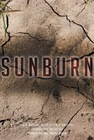 Sunburn