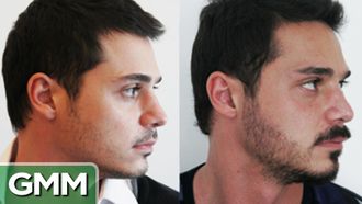 Episode 46 Beard Transplants Are Real
