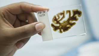 Episode 5 The Alzheimer's Project: Momentum in Science (Part 2)