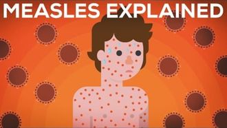 Episode 2 Measles Explained — Vaccinate or Not?